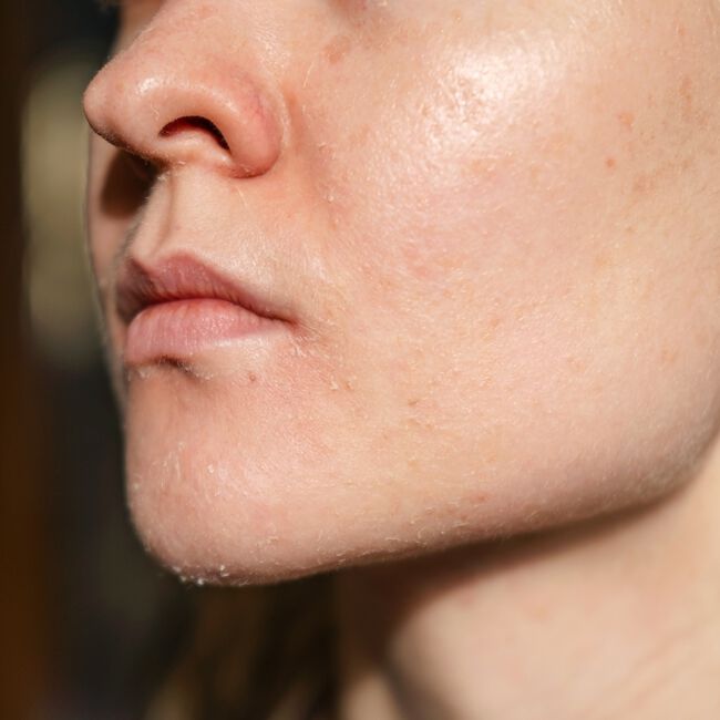 5 วิธีรักษาผิวแห้งกร้าน พร้อมฟื้นฟูผิวให้กลับมามีสุขภาพดี